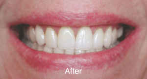 Dental before & after photos - The Dental Group of Galesburg - Dr. Cody Krech