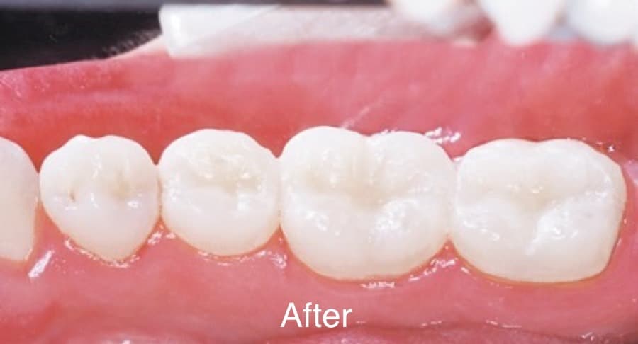 Dental before & after photos - The Dental Group of Galesburg - Dr. Cody Krech